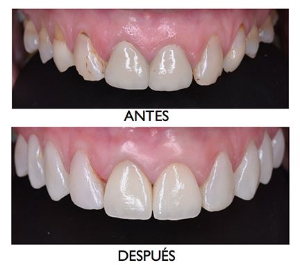 Carillas de en Córdoba - Clínica Dental Perán