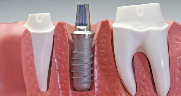 implantes_dentales_cordoba_clínica_dental_peran