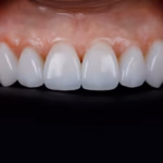 portada-carillas-dentales