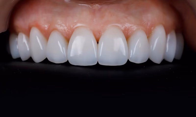 portada-carillas-dentales