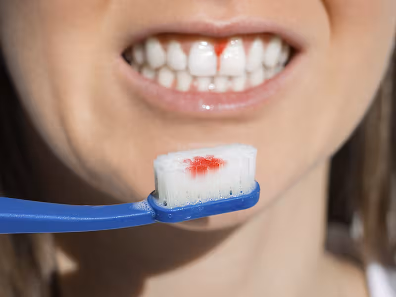 sangrado-de-encias-cepillo-dental